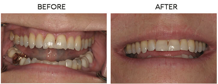 Cosmetic bonding before and after - Case 1