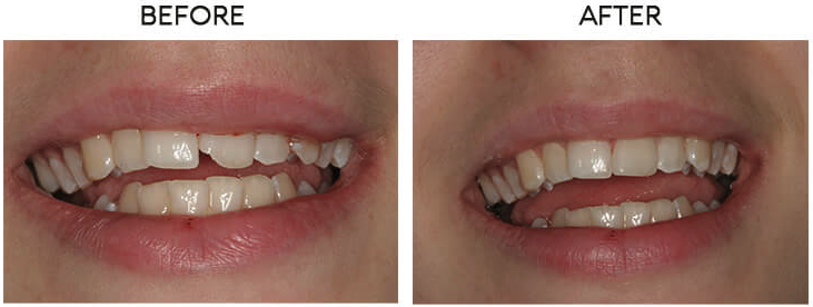 Cosmetic bonding before and after - Case 2