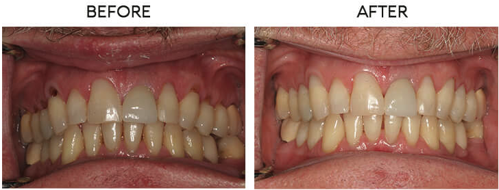 Cosmetic bonding before and after - Case 3