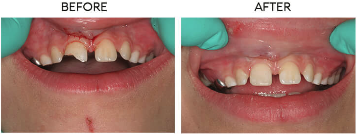 Cosmetic bonding before and after - Case 4