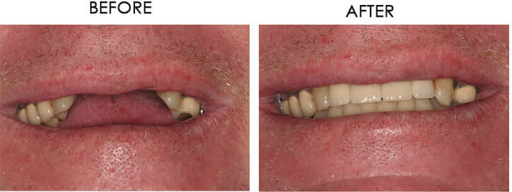 Dental implant case - implant-supported bridge for 4 front teeth