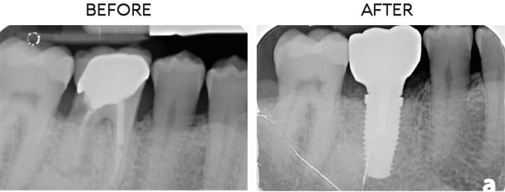 Dental implant before and after case 10