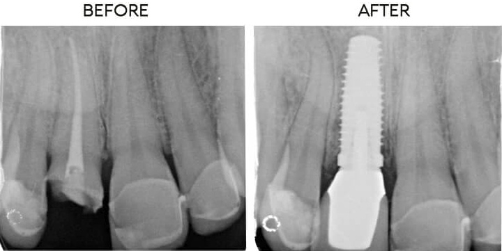 Dental implant before and after case 11