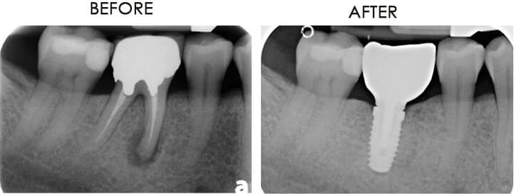 Dental implant before and after case 12