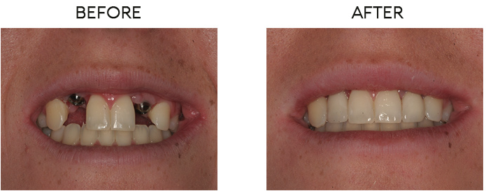 Missing front teeth replaced with 2 implant restorations