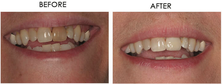Single tooth implant transformation