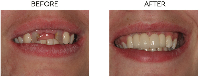 Pro bono implant-supported bridge restoration for oral trauma