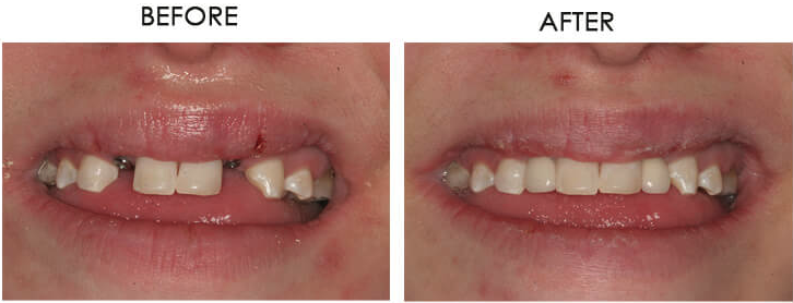 Tori's implant case - missing lateral incisors replaced