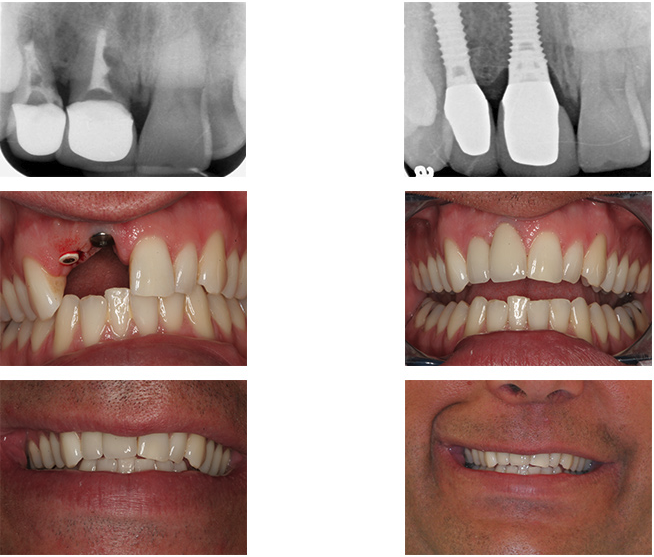 Conservative dental implant treatment for 2 unfixable teeth