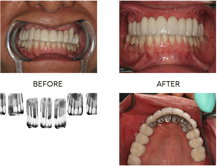 Implant-based smile makeover for failing restorative case