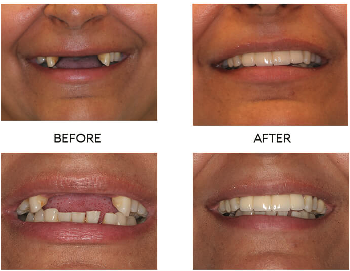 Dental implant before and after case 8