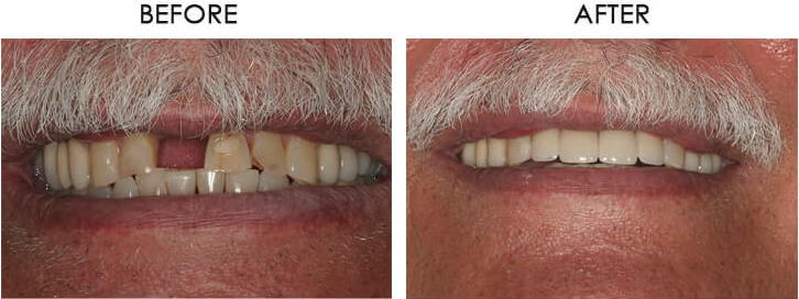 Joe's smile restoration with implant and 4 crowns